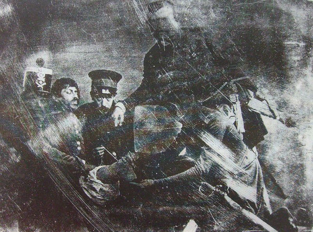 The First Photograph Capturing An Amputation